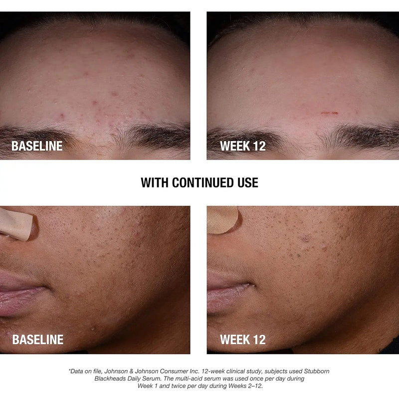Stubborn Blackheads Daily Acne Facial Serum with Salicylic, Glycolic, Polyhydroxy & Mandelic Acids, Oil-Free Face Serum for Acne-Prone Skin to Help Clear Clogged Pores, 1 Fl. Oz - Puck's